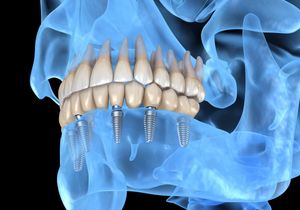 Featured image for “Are Dental Implants Noticeable?”