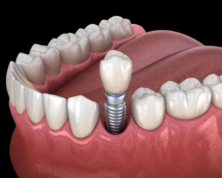 Featured image for “What to expect during a dental implant procedure?”