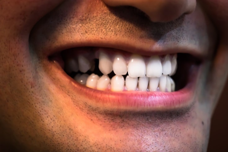 Featured image for “How Teeth Whitening Can Boost Your Confidence ?”