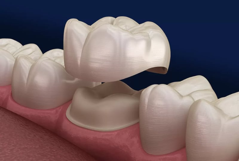 5 Benefits of a Dental Crown