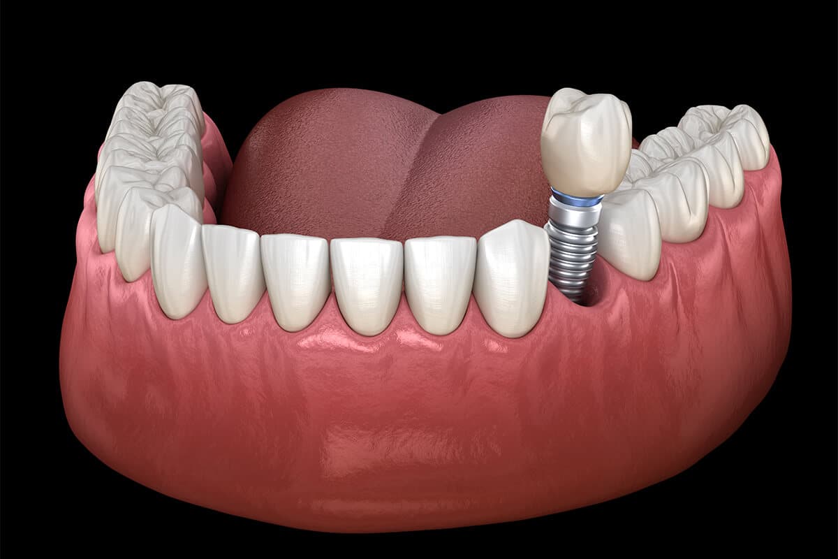 Featured image for “The Effect of Smoking on Dental Implants”