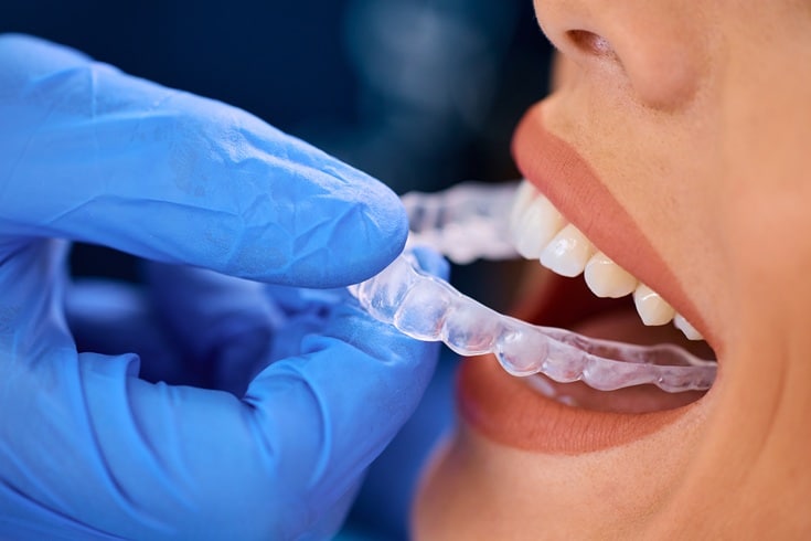 Featured image for “Unlocking Confidence: Invisalign Dentist In Houston”