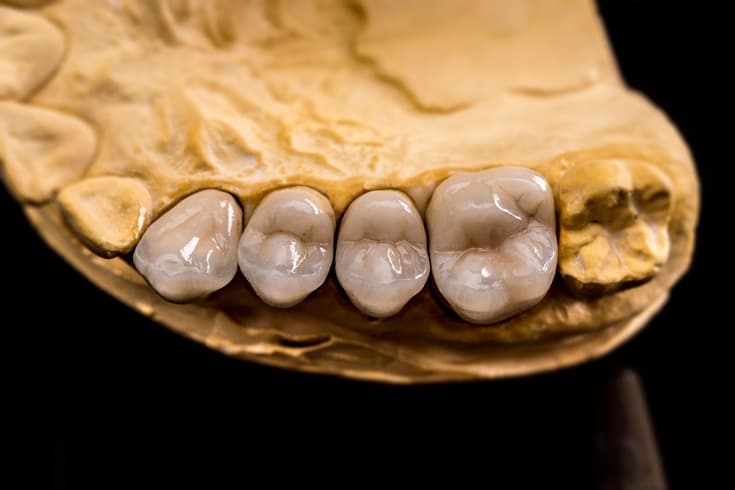 Featured image for “When Your Dental Crowns Break: A Comprehensive Guide”