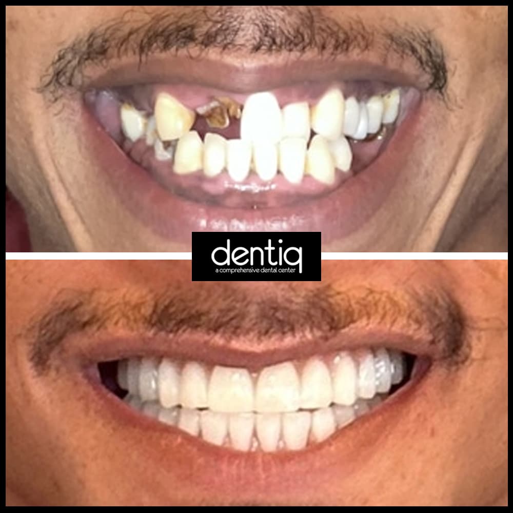 Single-Tooth-Implant