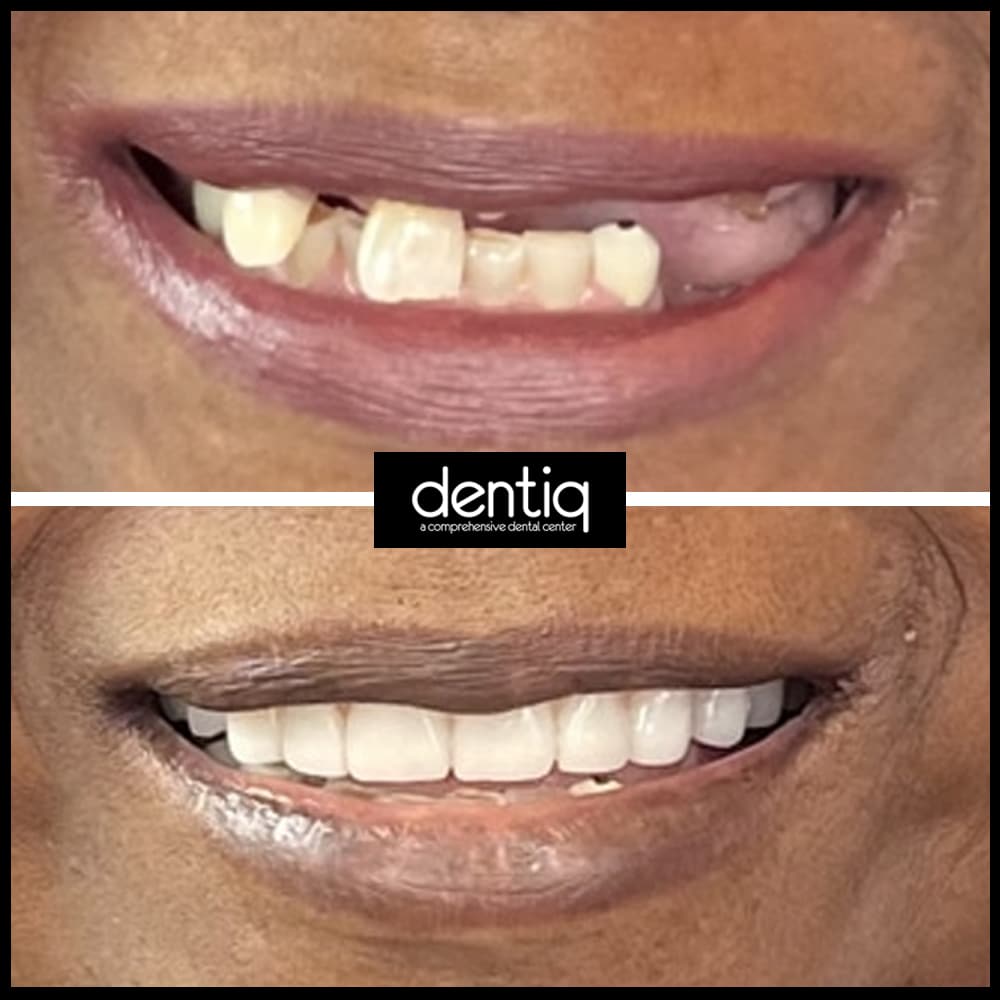 implant-before-after-one