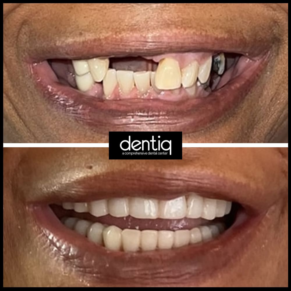 implant-before-after-three