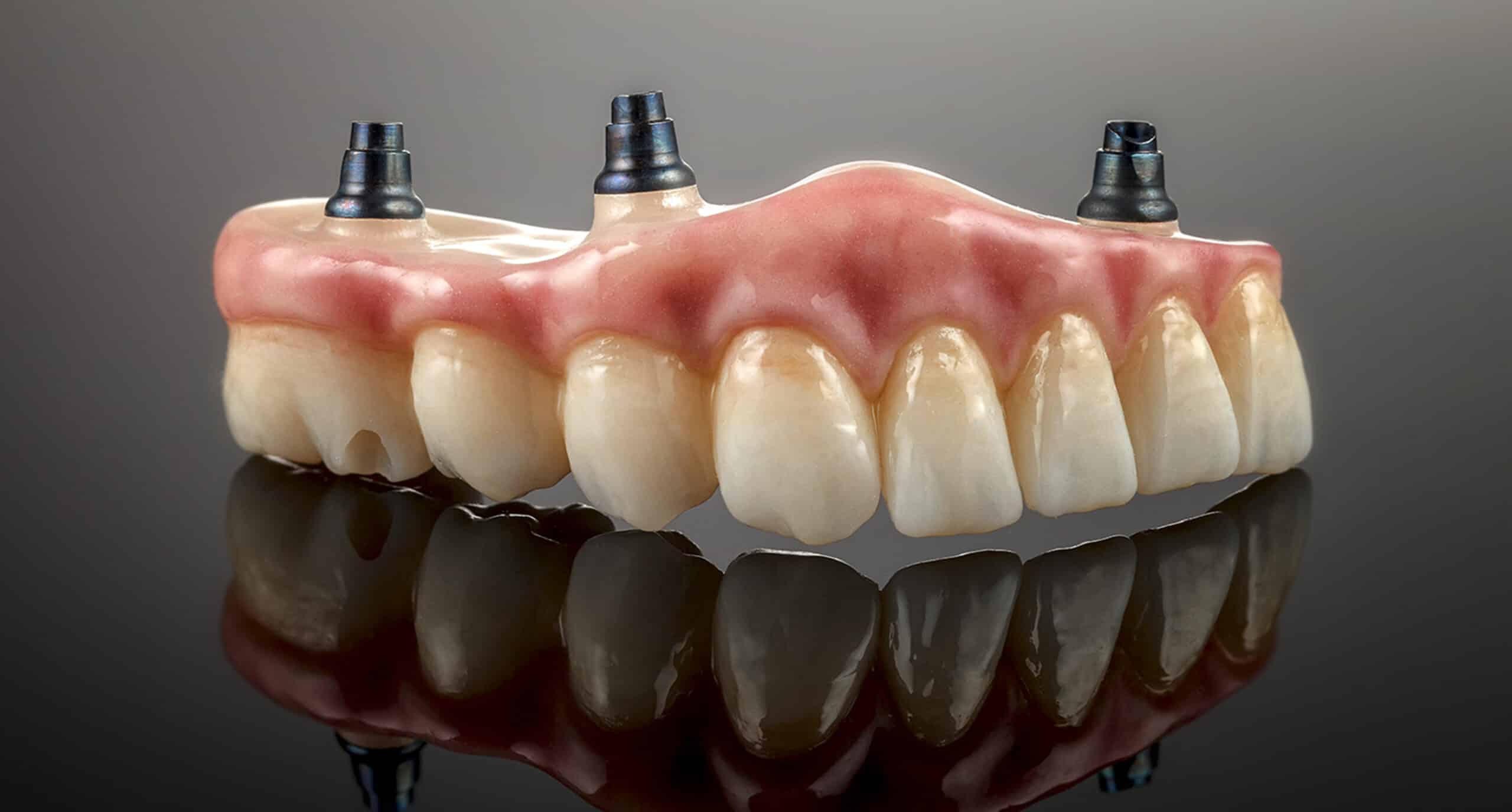 Featured image for “Implant-supported dentures for patients with bone loss”