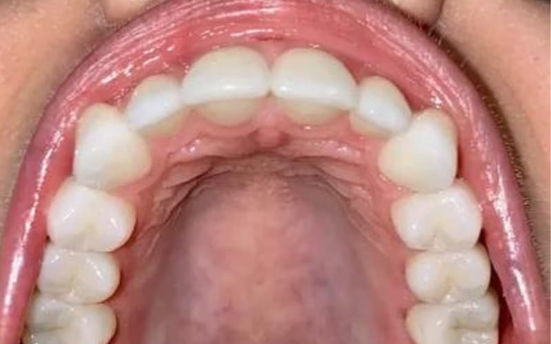 Featured image for “10 Reasons for a Lump on the Roof of the Mouth”