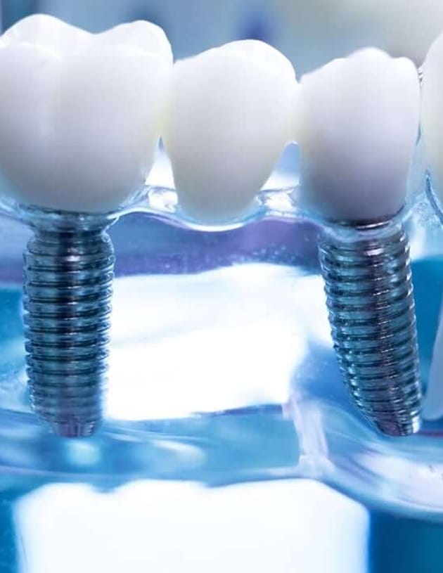 Dental Implant Process Houston