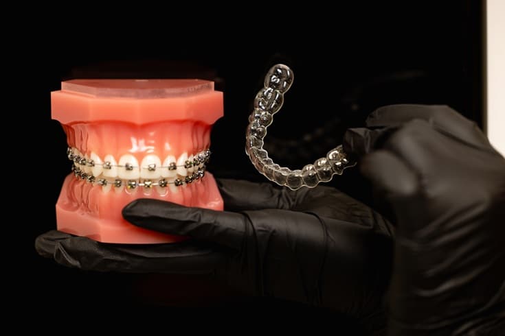 Featured image for “How Invisalign Costs Compare to Traditional Braces”
