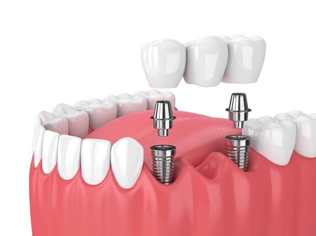 Single Tooth Implant