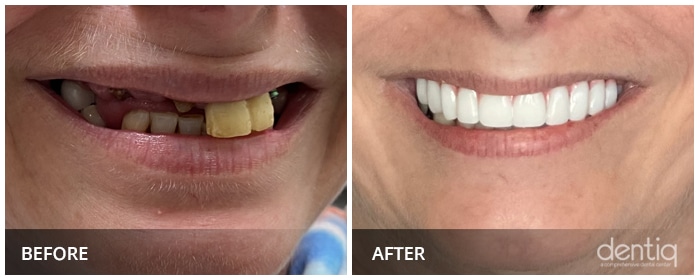 broken and decayed tooth before showing and after showing a perfect smile transformation images