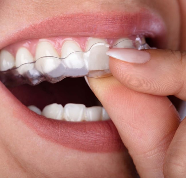 a girl wearing clear aligners for straightening teeth